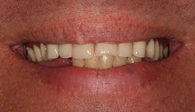 Before - Natural Smiles Implant & Cosmetic Dentistry