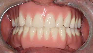 After - Natural Smiles Implant & Cosmetic Dentistry