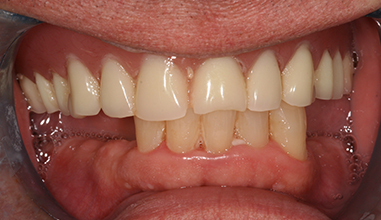 Before - Natural Smiles Implant & Cosmetic Dentistry