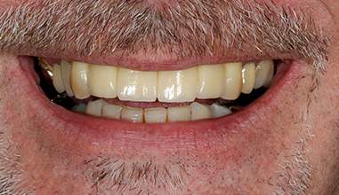 After - Natural Smiles Implant & Cosmetic Dentistry