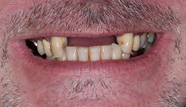 Before - Natural Smiles Implant & Cosmetic Dentistry