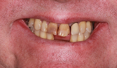 Before - Natural Smiles Implant & Cosmetic Dentistry