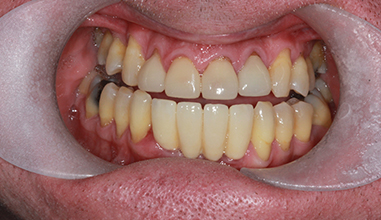 After - Natural Smiles Implant & Cosmetic Dentistry