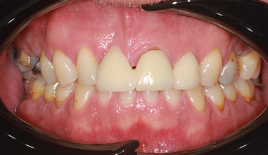 Before - Natural Smiles Implant & Cosmetic Dentistry