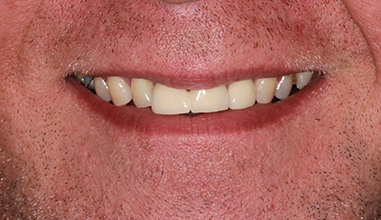 Before - Natural Smiles Implant & Cosmetic Dentistry
