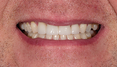 After - Natural Smiles Implant & Cosmetic Dentistry