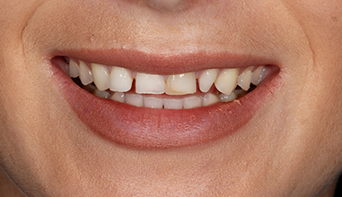 Before - Natural Smiles Implant & Cosmetic Dentistry