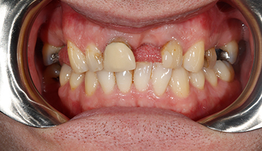 Before - Natural Smiles Implant & Cosmetic Dentistry