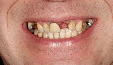 Before - Natural Smiles Implant & Cosmetic Dentistry
