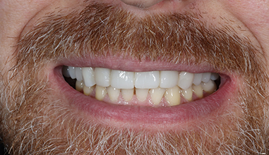 After - Natural Smiles Implant & Cosmetic Dentistry