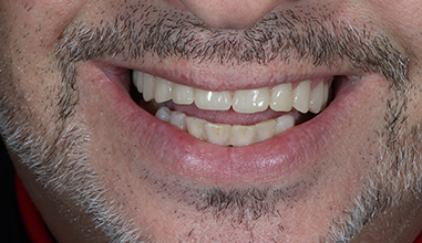 After - Natural Smiles Implant & Cosmetic Dentistry