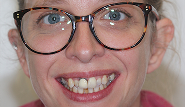 Before - Natural Smiles Implant & Cosmetic Dentistry