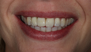 After - Natural Smiles Implant & Cosmetic Dentistry
