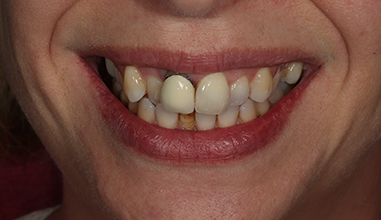 Before - Natural Smiles Implant & Cosmetic Dentistry
