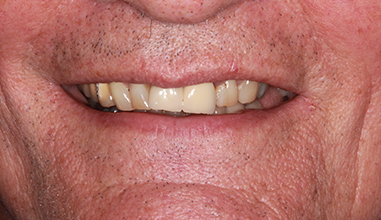 Before - Natural Smiles Implant & Cosmetic Dentistry