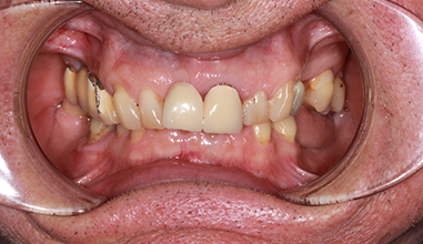 After - Natural Smiles Implant & Cosmetic Dentistry