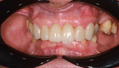 Before - Natural Smiles Implant & Cosmetic Dentistry