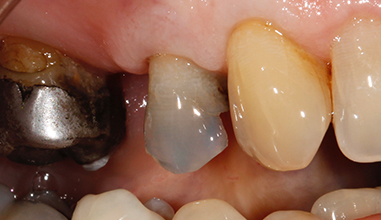Before - Natural Smiles Implant & Cosmetic Dentistry