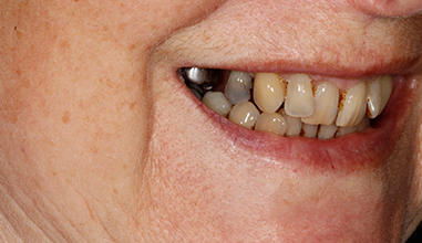 Before - Natural Smiles Implant & Cosmetic Dentistry