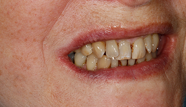 After - Natural Smiles Implant & Cosmetic Dentistry