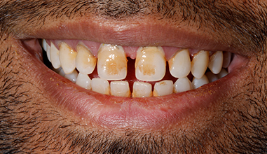 Before - Natural Smiles Implant & Cosmetic Dentistry