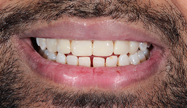 After - Natural Smiles Implant & Cosmetic Dentistry