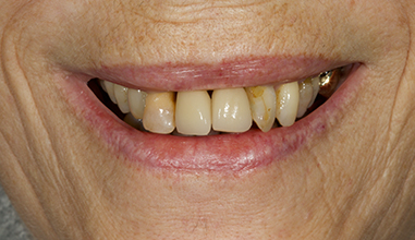 Before - Natural Smiles Implant & Cosmetic Dentistry