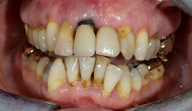 Before - Natural Smiles Implant & Cosmetic Dentistry