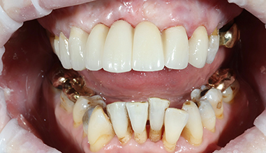 After - Natural Smiles Implant & Cosmetic Dentistry