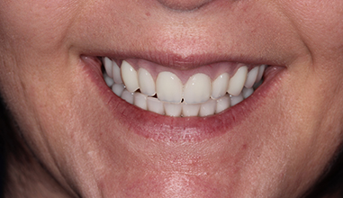 After - Natural Smiles Implant & Cosmetic Dentistry