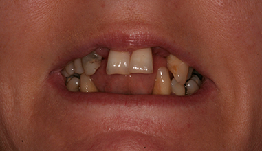 Before - Natural Smiles Implant & Cosmetic Dentistry