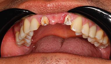 Before - Natural Smiles Implant & Cosmetic Dentistry