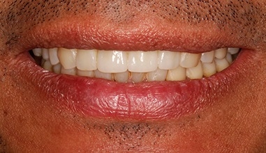 After - Natural Smiles Implant & Cosmetic Dentistry
