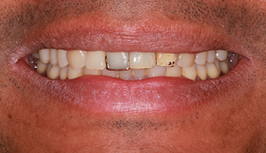 Before - Natural Smiles Implant & Cosmetic Dentistry
