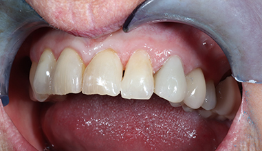 After - Natural Smiles Implant & Cosmetic Dentistry
