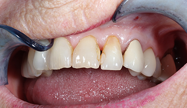 Before - Natural Smiles Implant & Cosmetic Dentistry