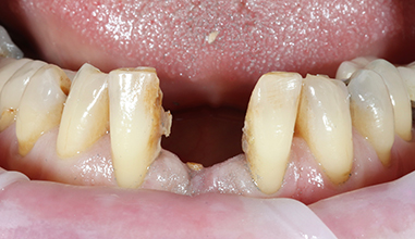 Before - Natural Smiles Implant & Cosmetic Dentistry