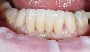 After - Natural Smiles Implant & Cosmetic Dentistry