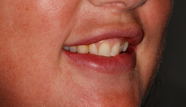 Before - Natural Smiles Implant & Cosmetic Dentistry