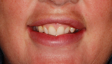 Before - Natural Smiles Implant & Cosmetic Dentistry