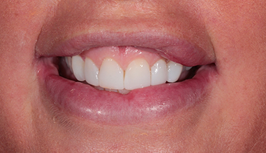 After - Natural Smiles Implant & Cosmetic Dentistry