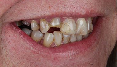 Before - Natural Smiles Implant & Cosmetic Dentistry