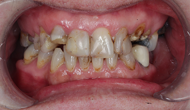 Before - Natural Smiles Implant & Cosmetic Dentistry