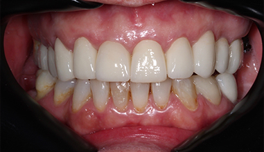 After - Natural Smiles Implant & Cosmetic Dentistry