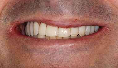After - Natural Smiles Implant & Cosmetic Dentistry