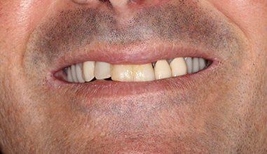 Before - Natural Smiles Implant & Cosmetic Dentistry