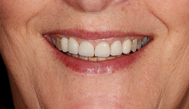 After - Natural Smiles Implant & Cosmetic Dentistry