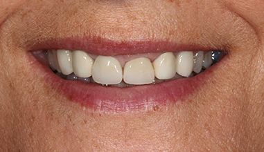 Before - Natural Smiles Implant & Cosmetic Dentistry