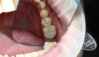 After - Natural Smiles Implant & Cosmetic Dentistry