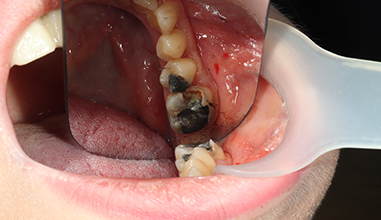 Before - Natural Smiles Implant & Cosmetic Dentistry